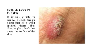 FOREIGN BODY IN
THE SKIN
It is usually safe to
remove a small foreign
object such as a wood
splinter, thorn, fiber
glass, or glass that's just
under the surface of the
skin.
 