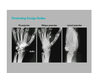 FOREIGN BODY RADIOGRAPHY MEDICAL IMAGING.ppt