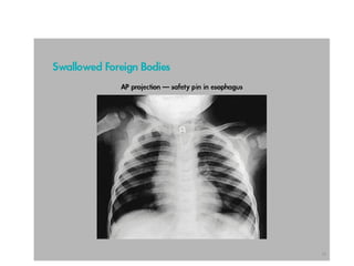FOREIGN BODY RADIOGRAPHY MEDICAL IMAGING.ppt