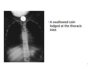 Coin Stack Sign Radiology FOREIGN BODY RADIOGRAPHY MEDICAL IMAGING.ppt