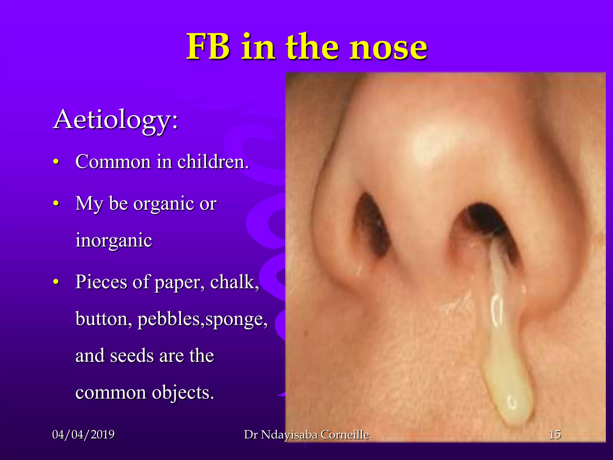 forein-body-in-the-ear-and-the-nose-management-pptx