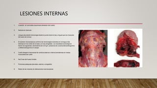 LESIONES INTERNAS
1. Luxación en cervicales (equimosis alrededor del cuello)
2. fractura en clavicula.
3. Lengua abundante hemorragia desde la punta hacia la bas, al igual que los músculos
del suelo de la boca
4. El examen microscópicos confirmo las hemorragias recientes en la lengua más
intensas en los cortes de la base y en las amígdalas. Los resultados toxicológicos
fueron los siguientes: alcoholemia de 0,43 gr/l, presencia de cocaína,Benzoillecgonina
y etilbenzoilecgonina en sangre.
5. Cuello:desgarro transversal de carotica externa e interna,hematomas en masas
musculares del cuello
6. fracTuras del hueso hioides
7. Pulmones petequias pleurales ,edema y congestión
8. Resto de las vísceras sin alteraciones macroscopicas
 