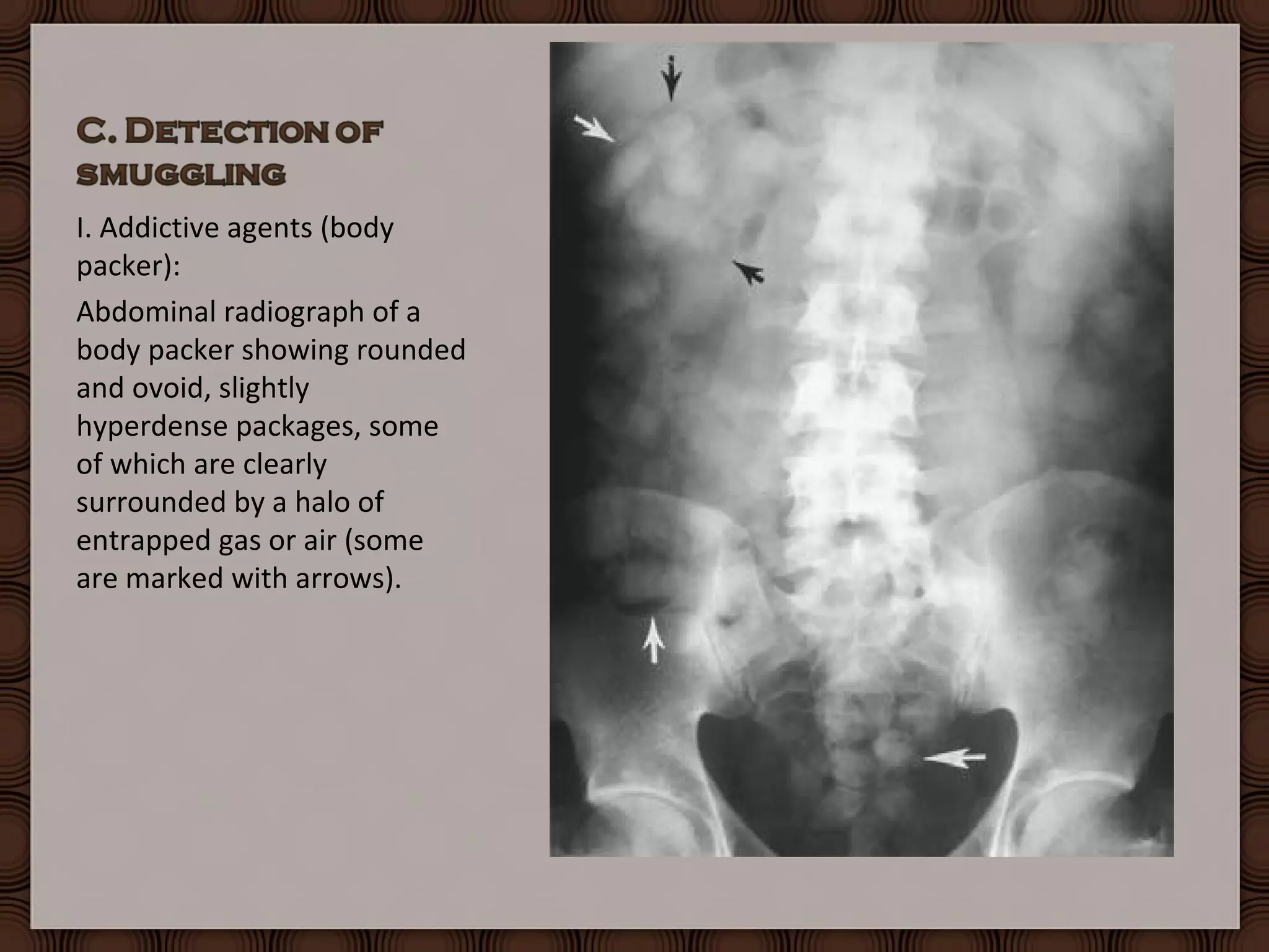 Forensic Radiology Practical Under | PPT