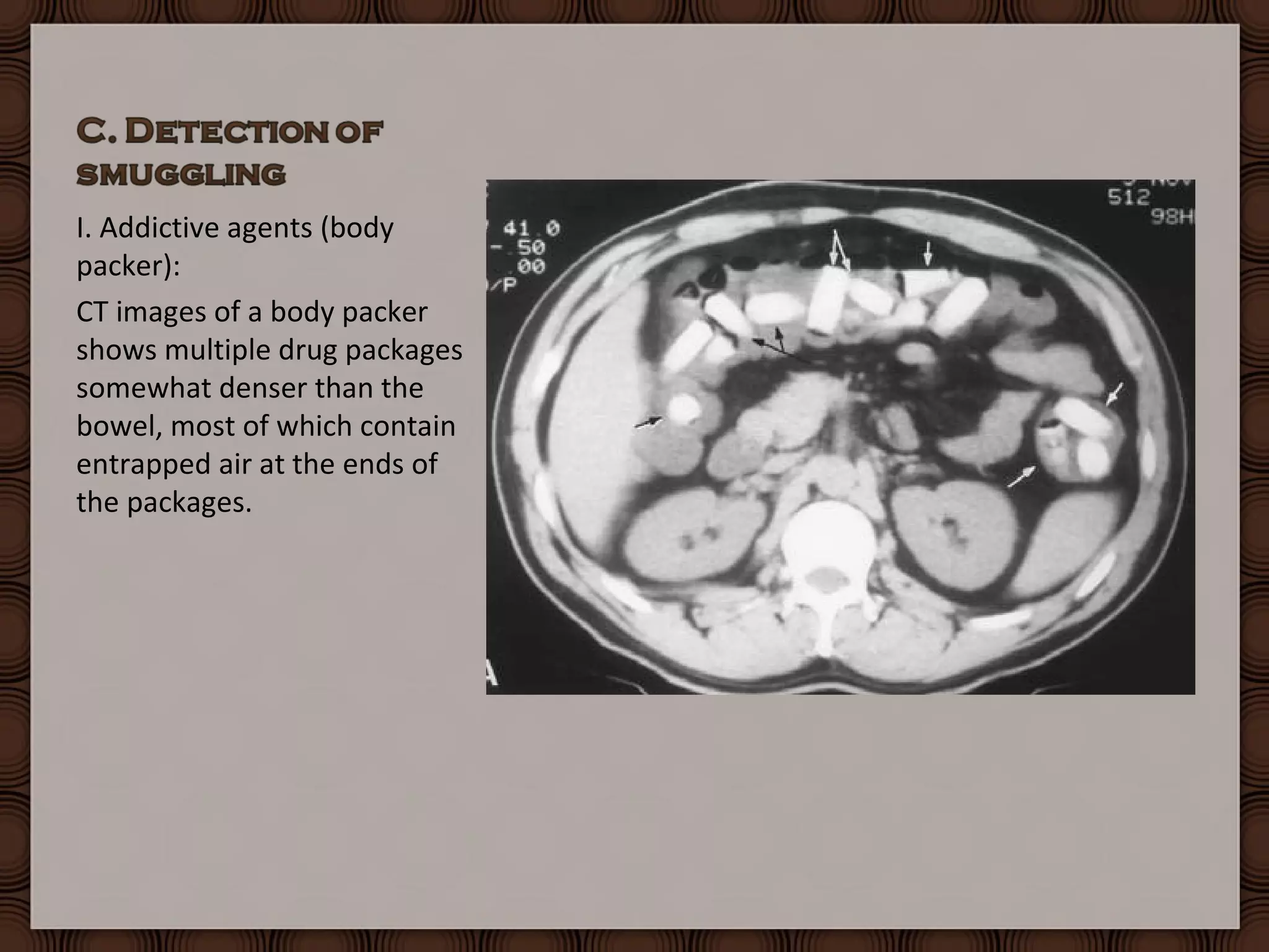 Forensic Radiology Practical Under | PPT
