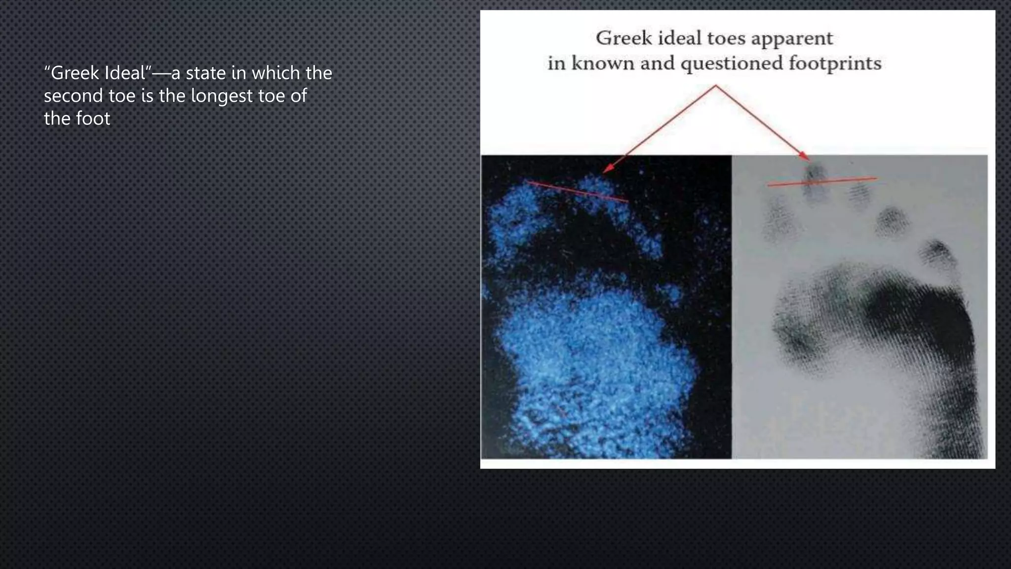 “Greek Ideal”—a state in which the
second toe is the longest toe of
the foot
