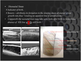 # Indicator of birth.
# Bowers – attributes its formation to the slowing down of enamel prism
growth rate,thus “creating an apparent line of demarcation.
• Ciapparelli-the neonatal lines may take upto 3wks after birth to form.Hence
absence of NN line still birth !
prenatal enamel
neonatal line
dentin
postnatal enamel
 