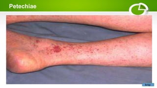 Petechiae
knip
 