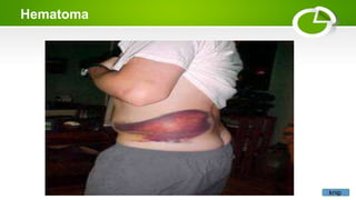 Hematoma
knip
 