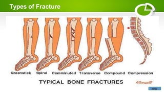 Types of Fracture
knip
 