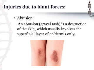 Injuries due to blunt forces:
• Abrasion:
An abrasion (gravel rash) is a destruction
of the skin, which usually involves the
superficial layer of epidermis only.
 