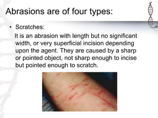 Abrasions are of four types:
• Scratches:
It is an abrasion with length but no significant
width, or very superficial incision depending
upon the agent. They are caused by a sharp
or pointed object, not sharp enough to incise
but pointed enough to scratch.
 