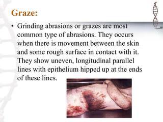Graze:
• Grinding abrasions or grazes are most
common type of abrasions. They occurs
when there is movement between the skin
and some rough surface in contact with it.
They show uneven, longitudinal parallel
lines with epithelium hipped up at the ends
of these lines.
 