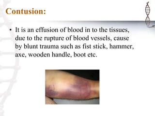 Contusion:
• It is an effusion of blood in to the tissues,
due to the rupture of blood vessels, cause
by blunt trauma such as fist stick, hammer,
axe, wooden handle, boot etc.
 
