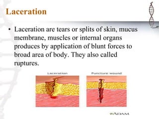 Laceration
• Laceration are tears or splits of skin, mucus
membrane, muscles or internal organs
produces by application of blunt forces to
broad area of body. They also called
ruptures.
 