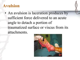 Avulsion
• An avulsion is laceration produces by
sufficient force delivered to an acute
angle to detach a portion of
traumatized surface or viscus from its
attachments.
 