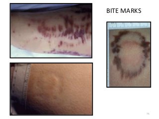 10/6/2016 saurabh bhargava 75
BITE MARKS
 