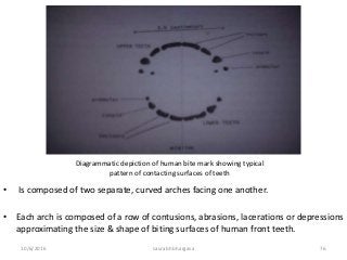 10/6/2016 saurabh bhargava 76
Diagrammatic depiction of human bite mark showing typical
pattern of contacting surfaces of teeth
• Is composed of two separate, curved arches facing one another.
• Each arch is composed of a row of contusions, abrasions, lacerations or depressions
approximating the size & shape of biting surfaces of human front teeth.
 