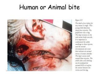 10/6/2016 saurabh bhargava 86
Human or Animal bite
 