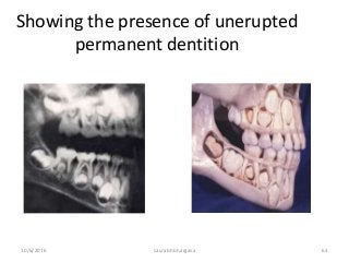 10/6/2016 saurabh bhargava 63
Showing the presence of unerupted
permanent dentition
 