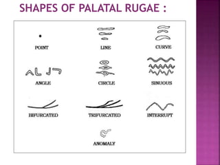 SHAPES OF PALATAL RUGAE :
 