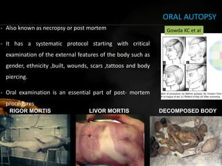 ORAL AUTOPSY
• Also known as necropsy or post mortem
• It has a systematic protocol starting with critical
examination of the external features of the body such as
gender, ethnicity ,built, wounds, scars ,tattoos and body
piercing.
• Oral examination is an essential part of post- mortem
procedures
RIGOR MORTIS LIVOR MORTIS DECOMPOSED BODY
12
Gowda KC et al
 