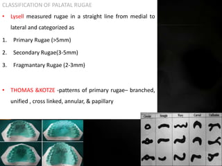 CLASSIFICATION OF PALATAL RUGAE
• Lysell measured rugae in a straight line from medial to
lateral and categorized as
1. Primary Rugae (>5mm)
2. Secondary Rugae(3-5mm)
3. Fragmantary Rugae (2-3mm)
• THOMAS &KOTZE -patterns of primary rugae– branched,
unified , cross linked, annular, & papillary
28
 