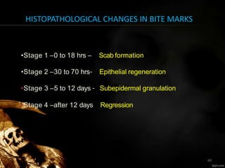 HISTOPATHOLOGICAL CHANGES IN BITE MARKS
•Stage 1 –0 to 18 hrs – Scab formation
•Stage 2 –30 to 70 hrs‐ Epithelial regeneration
•Stage 3 –5 to 12 days ‐ Subepidermal granulation
•Stage 4 –after 12 days – Regression
60
 