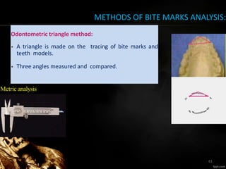 METHODS OF BITE MARKS ANALYSIS:
Odontometric triangle method:
• A triangle is made on the tracing of bite marks and
teeth models.
• Three angles measured and compared.
Metric analysis
61
 