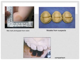 Bite mark photograph from victim Models from suspects
comparison
 