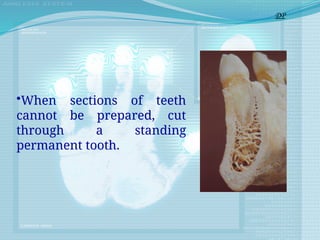 •When sections of teeth
cannot be prepared, cut
through a standing
permanent tooth.
DP
 