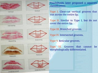 Tsuchihashi later proposed a separate
classification:
Type I. Clear-cut vertical grooves that
run across the entire lip.
Type II. Similar to Type I, but do not
cover the entire lip.
Type III. Branched grooves.
Type IV. Intersected grooves.
Type V. Reticular grooves.
Type VI. Grooves that cannot be
morphologically differentiated.
 