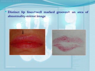  Distinct lip lines+well marked grooves+ an area of
abnormality-mirror image
 