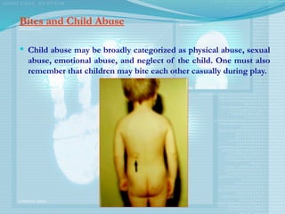 Bites and Child Abuse
 Child abuse may be broadly categorized as physical abuse, sexual
abuse, emotional abuse, and neglect of the child. One must also
remember that children may bite each other casually during play.
 