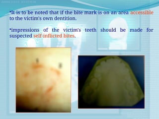 •It is to be noted that if the bite mark is on an area accessible
to the victim's own dentition.
•impressions of the victim's teeth should be made for
suspected self-inflicted bites.
 