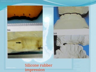 Silicone rubber
impression
 