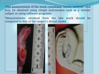 •The measurement of the mark constitutes 'metric analysis', and
may be obtained using simple instruments such as a vernier
caliper or using software programs.
•Measurements obtained from the bite mark should be
compared to that of the suspect's dental model.
 