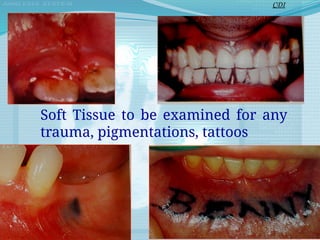Soft Tissue to be examined for any
trauma, pigmentations, tattoos
CDI
 
