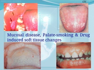Mucosal disease, Palate-smoking & Drug
induced soft tissue changes
CDI
 