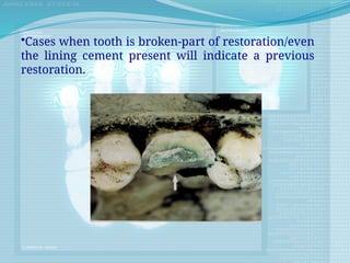 •Cases when tooth is broken-part of restoration/even
the lining cement present will indicate a previous
restoration.
 