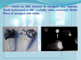  Fire - metal act diff, mercury in amalgam may vaporize.
Teeth incinerated at 600 o
c-chalky white, extremely friable.
Piece of amalgam still visible.
 