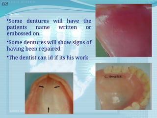 •Some dentures will have the
patients name written or
embossed on.
•Some dentures will show signs of
having been repaired
•The dentist can id if its his work
CDI
 