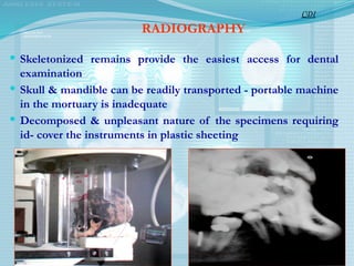 RADIOGRAPHY
 Skeletonized remains provide the easiest access for dental
examination
 Skull & mandible can be readily transported - portable machine
in the mortuary is inadequate
 Decomposed & unpleasant nature of the specimens requiring
id- cover the instruments in plastic sheeting
CDI
 