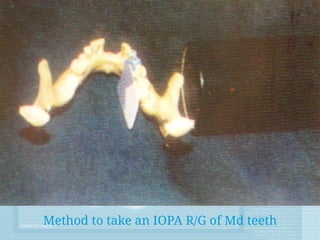 Method to take an IOPA R/G of Md teeth
 