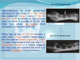 Jaw of 26 week fetus
Jaw of 30 weeks fetus
•Mineralisation of tooth germs-well
advanced in ant, crypt of 1st
dec molar
min outline of 2 cusps r seen, 2nd
dec M-
min of 1 cusp is visible, as this process
starts at about 6 months of IU life this
child was about 26 weeks from
conception at the time of death.
•More min of ant, 2nd
dec M contains a
tooth with 5 cusps which r beginning to
min but still are widely separated, 1st
dec
M cusps r beginning to fuse but still r not
completely united, a # which suggests
that fetus has not reached full term & is
probably 30 weeks from conception
 