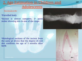 First 2 decades of life:
•Putrefied body
•Incisor is almost complete, 1st
perm
molar showing min in one of the cusps
•Histological sections of the incisor from
the same pt shows that the degree of root
dev confirms the age of 3 months after
birth
DP
2. Age Estimation in Children and
Adolescents
 