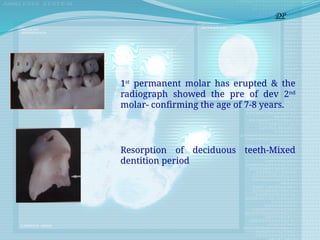 1st
permanent molar has erupted & the
radiograph showed the pre of dev 2nd
molar- confirming the age of 7-8 years.
Resorption of deciduous teeth-Mixed
dentition period
DP
 