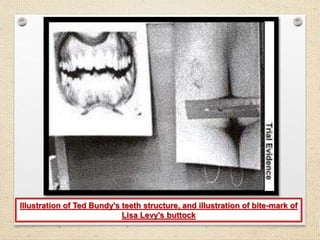 Illustration of Ted Bundy's teeth structure, and illustration of bite-mark of
Lisa Levy's buttock
 