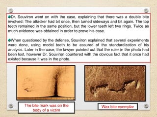 Dr. Souviron went on with the case, explaining that there was a double bite
involved: The attacker had bit once, then turned sideways and bit again. The top
teeth remained in the same position, but the lower teeth left two rings. Twice as
much evidence was obtained in order to prove his case.
When questioned by the defense, Souviron explained that several experiments
were done, using model teeth to be assured of the standardization of his
analysis. Later in the case, the lawyer pointed out that the ruler in the photo had
been lost, however Dr. Souviron countered with the obvious fact that it once had
existed because it was in the photo.
The bite mark was on the
body of a victim
Wax bite exemplar
 
