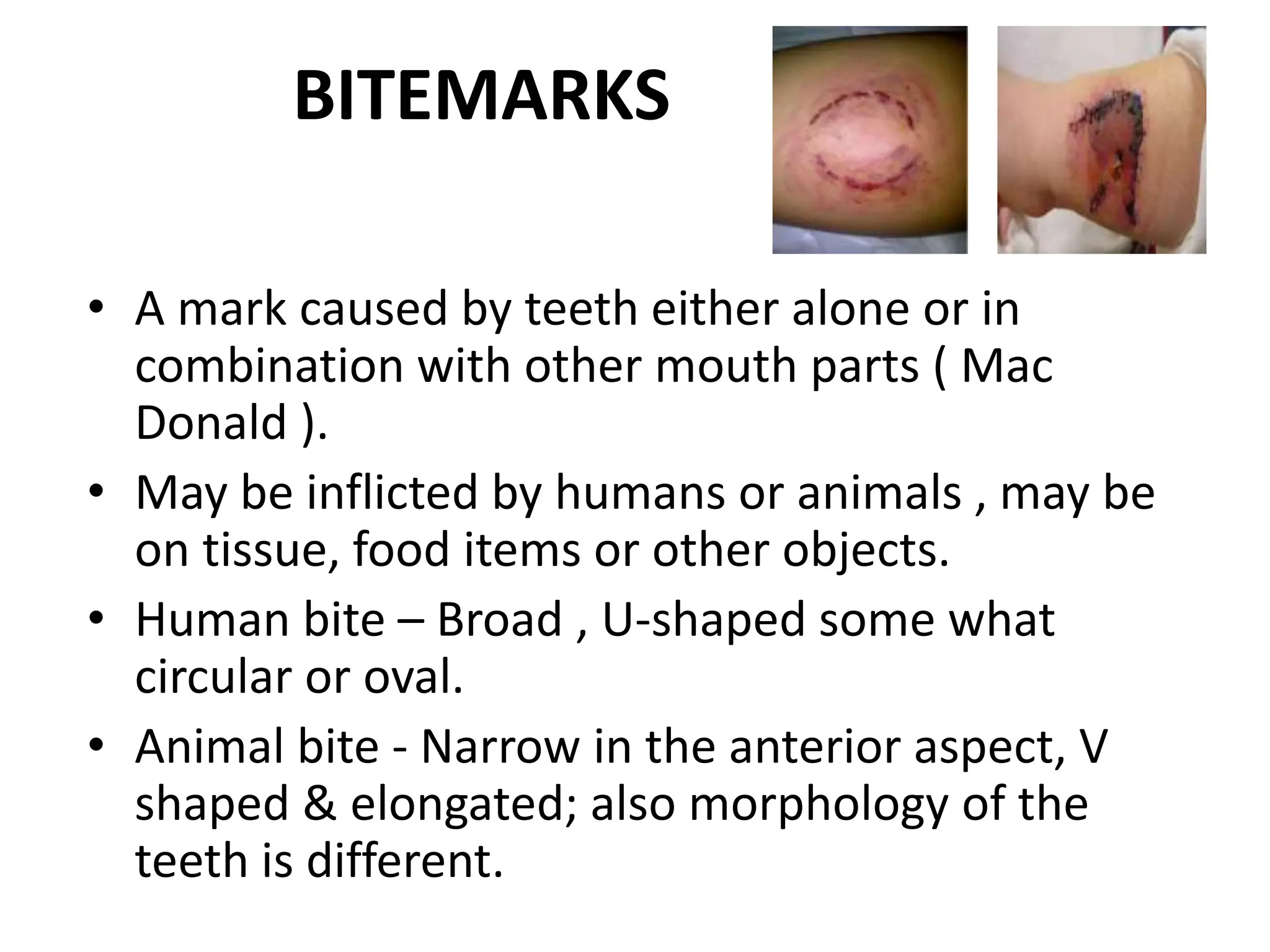BITEMARKS
• A mark caused by teeth either alone or in
combination with other mouth parts ( Mac
Donald ).
• May be inflicted by humans or animals , may be
on tissue, food items or other objects.
• Human bite – Broad , U-shaped some what
circular or oval.
• Animal bite - Narrow in the anterior aspect, V
shaped & elongated; also morphology of the
teeth is different.
 