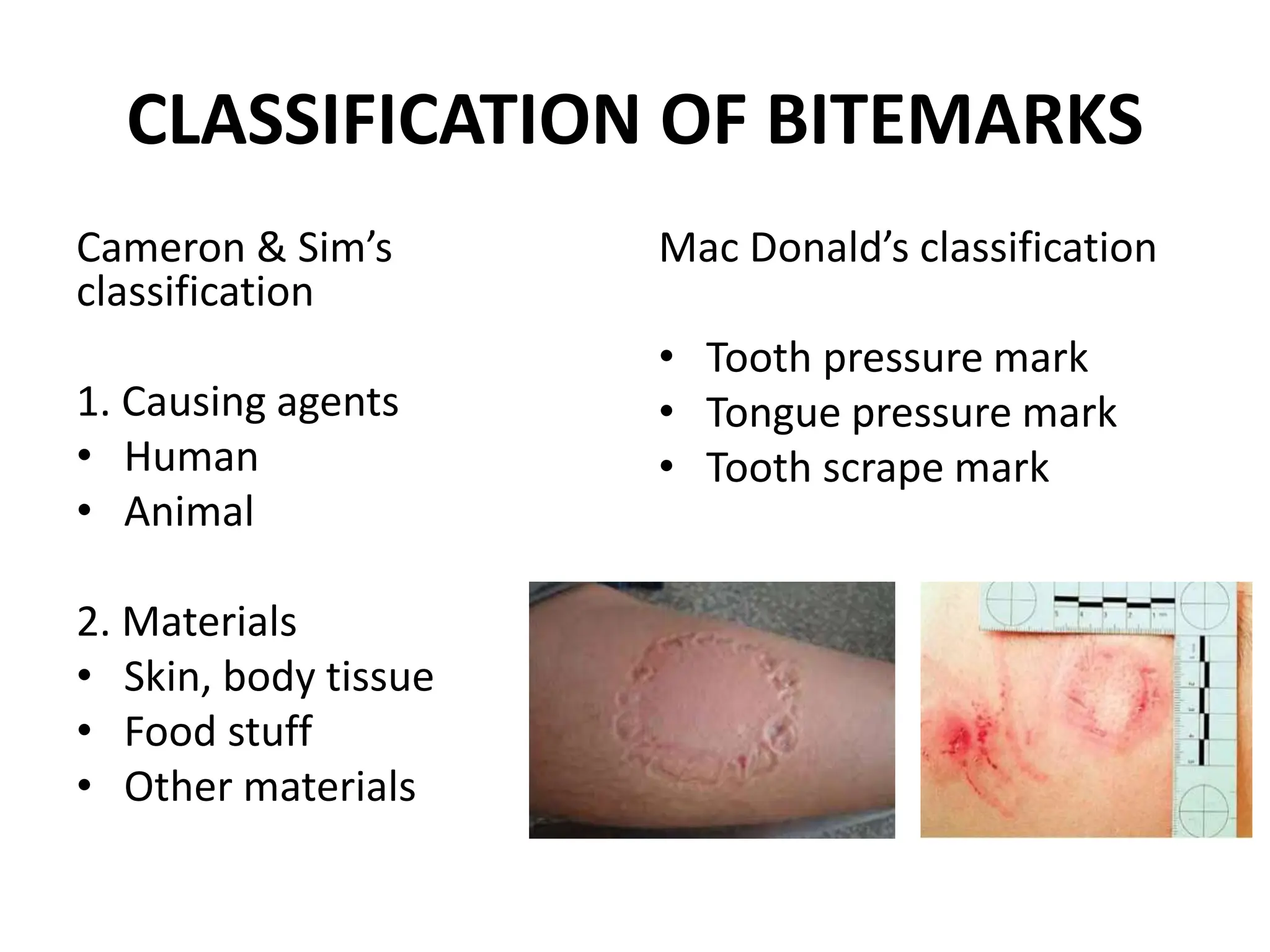 CLASSIFICATION OF BITEMARKS
Cameron & Sim’s
classification
1. Causing agents
• Human
• Animal
2. Materials
• Skin, body tissue
• Food stuff
• Other materials
Mac Donald’s classification
• Tooth pressure mark
• Tongue pressure mark
• Tooth scrape mark
 